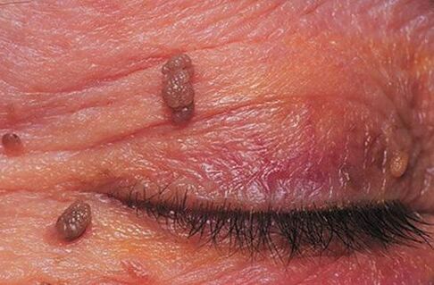 Papilloma on the eyelid skin that needs treatment