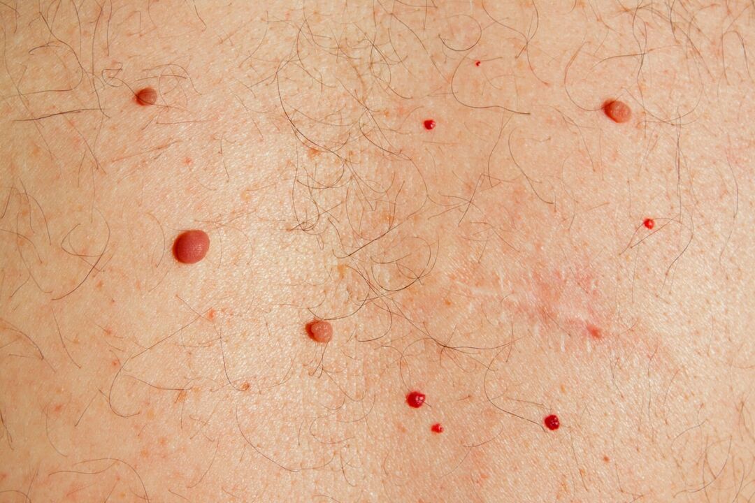 Papilloma on the body caused by HPV