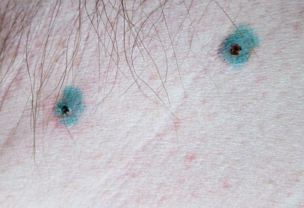 Signs on the skin after papilloma laser removal