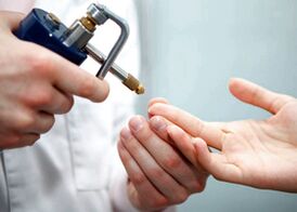 Removing warts on fingers using liquid nitrogen