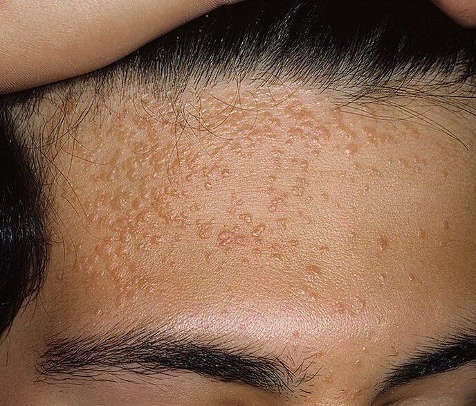 Average papilloma on the forehead