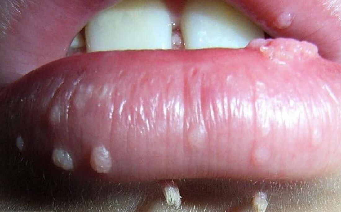 Papilloma of the lips