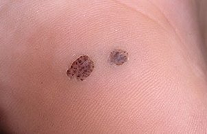 warts in the palm of your hand